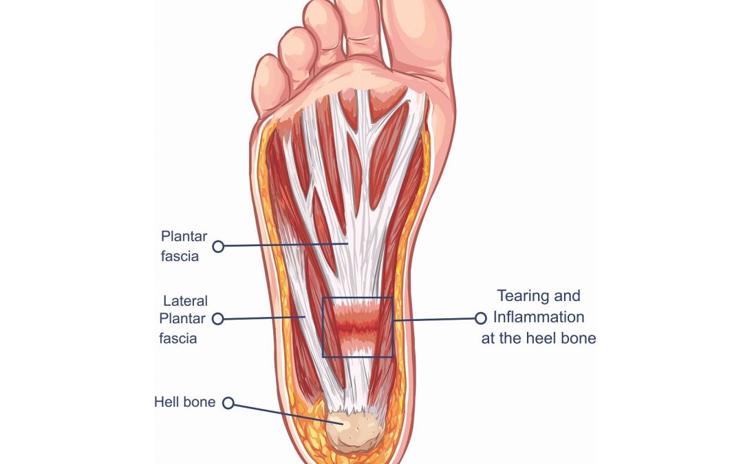 Adelaide Podiatrists Answer Plantar Fasciitis Questions