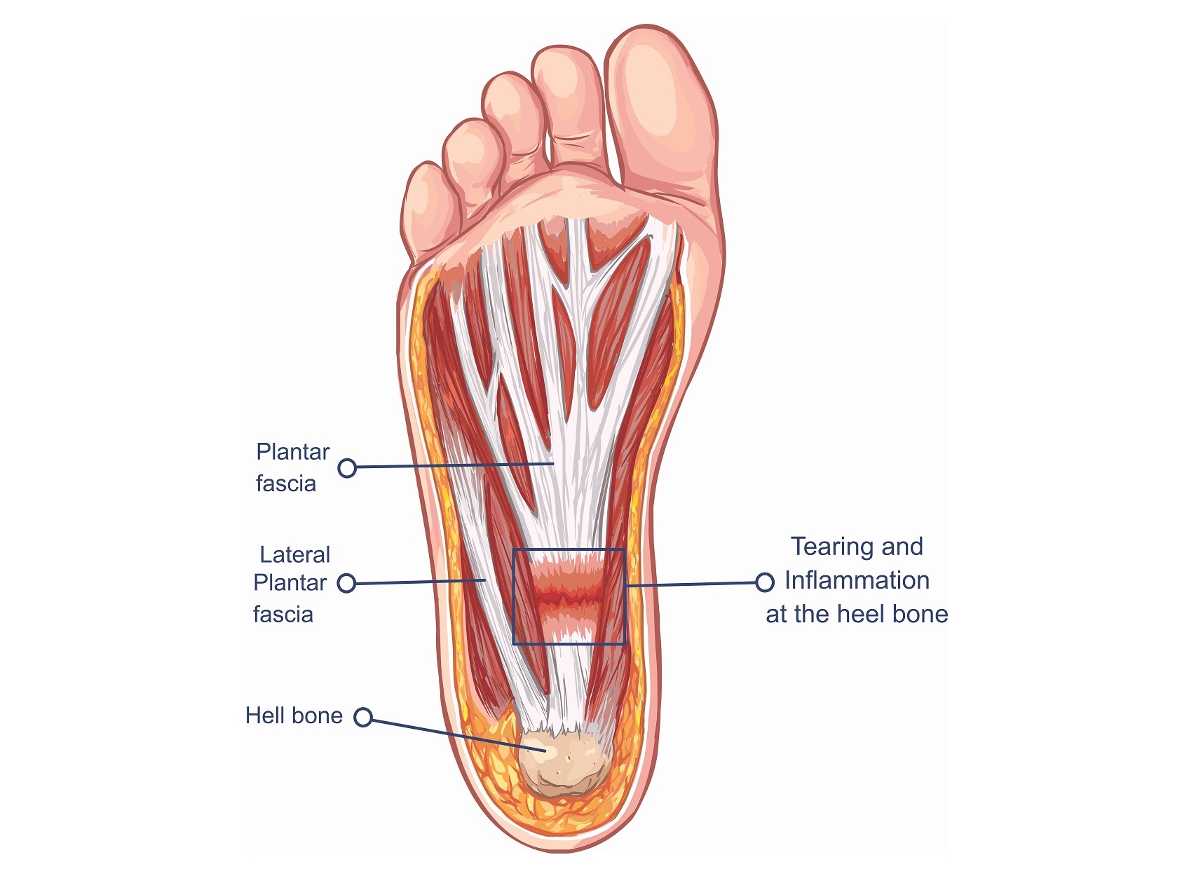 PLANTAR FASCIA STRETCH - Exercises, workouts and routines